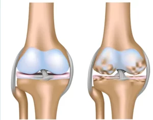 остеоартроз коленного сустава