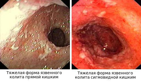 Неспецифический язвенный колит - симптомы и лечение