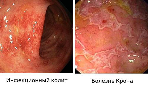 Неспецифический язвенный колит - симптомы и лечение