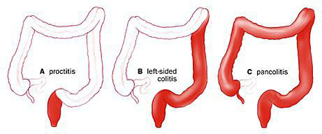 Неспецифический язвенный колит - симптомы и лечение
