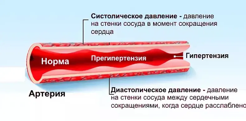 2 Причины артериальной гипертензии (гипертонии)